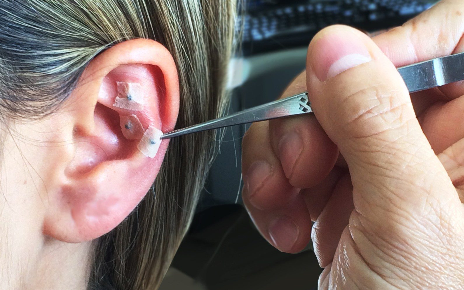 Auriculoterapia alivia dores e melhora mobilidade de incapacitados por chikungunya